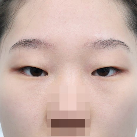 쌍수 후 눈화장, 안전하게 시작할 수 있는 시기는? 관련 이미지 2