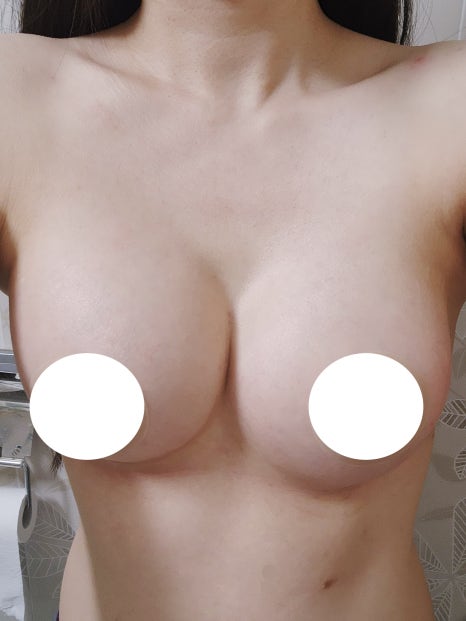 가슴수술 후 통증, 언제까지 얼마나 아픈 게 정상일까 관련 이미지 9