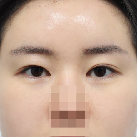 소세지눈 재수술, 무조건 빠를수록 좋다는 말이 맞을까요 관련 이미지 3