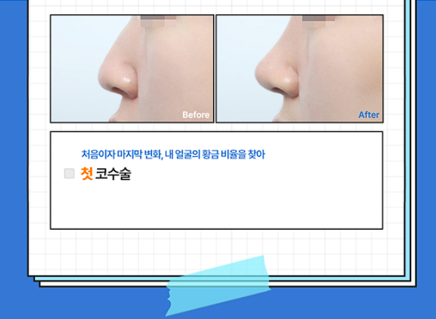 [글로비성형외과] 여름방학 이벤트! 눈&middot;코&middot;바디 라인 혜택 정리 관련 이미지 4