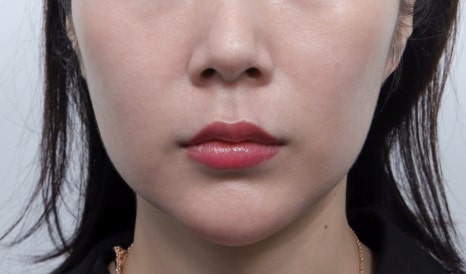 처진 얼굴 리프팅, 나이보다 더 들어보인다면? 관련 이미지 6