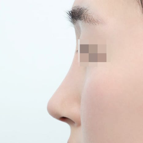 Natural-Yet-Glamorous Rhinoplasty: Is It Possible to Achieve Both Glamour and Naturalness? image 8