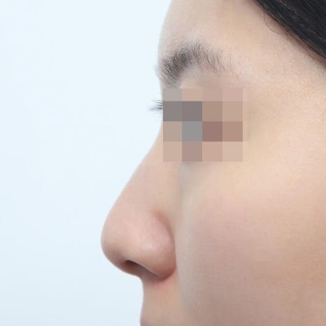 코성형후붓기, 수술 후 한 달이 가장 힘들다는 말, 진짜일까 관련 이미지 3