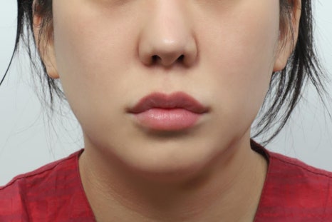 Philtrum Reduction Review: The Real Story No One Tells You image 3