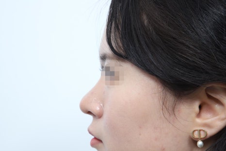 코성형 개방과 비개방, 나에게 맞는 수술방식이 궁금하다면 읽어보세요 관련 이미지 3