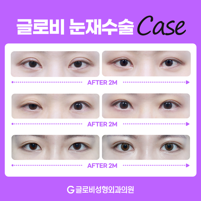 쌍꺼풀재수술잘하는병원 선택 전 주의사항 관련 이미지 4