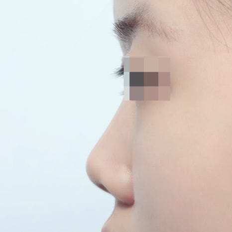 자가연골 코성형 비용, 왜 이렇게 차이가 날까요? 관련 이미지 3