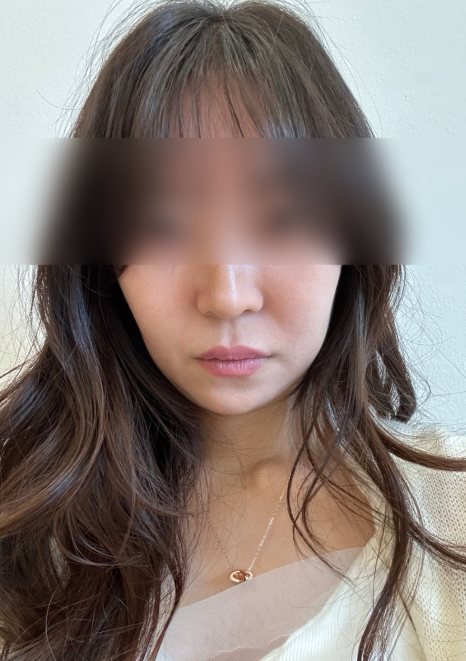 Thread-Lifting Side Effects: Changes That May Occur After the Procedure image 7