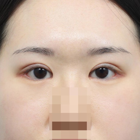 쌍꺼풀수술 재수술 시기, 언제 시작하는 게 좋을까? 관련 이미지 8