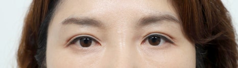 Upper Blepharoplasty: How to Improve Covered, Drooping Eyelids image 4