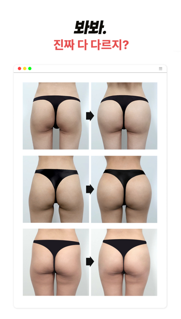 바디필러 시술 전 확인? 이것 모르고 맞으면 후회합니다 관련 이미지 7