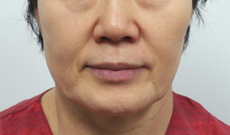 처진 얼굴 리프팅, 나이보다 더 들어보인다면? 관련 이미지 3