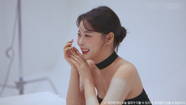 눈밑지방재배치수술 리얼후기 2탄｜수술 한달 후 경과확인! 관련 이미지 16