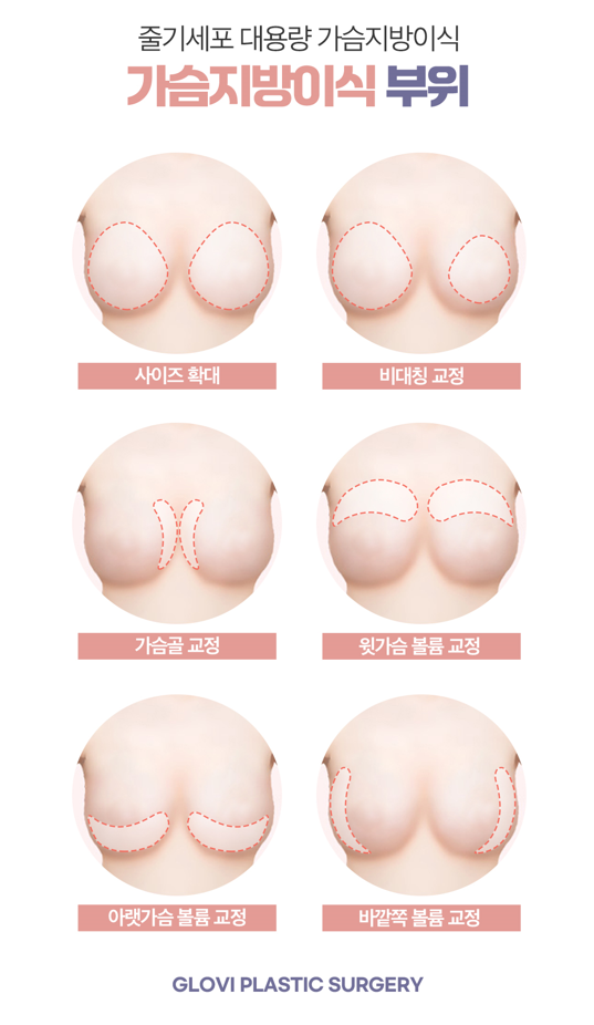 가슴지방이식가격과 가슴지방이식후 관리방법 관련 이미지 7