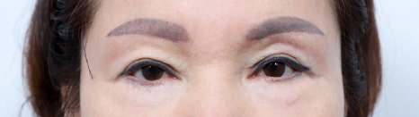 Middle-Aged Eye Surgery: Understanding Eye Surgery Options by Age image 2