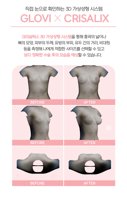 가슴 성형 잘하는곳, 후기보다 중요한 병원 선택의 기준 관련 이미지 6