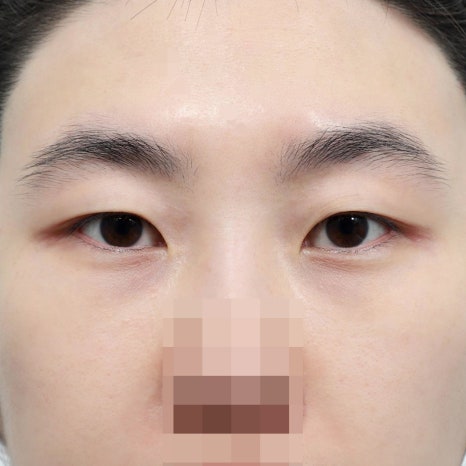 쌍수 후 눈화장, 안전하게 시작할 수 있는 시기는? 관련 이미지 8
