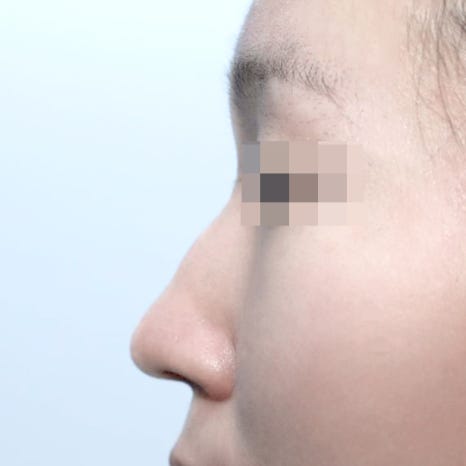 Short Nose Revision Surgery: First Identify the Cause of the Previous Failure image 6