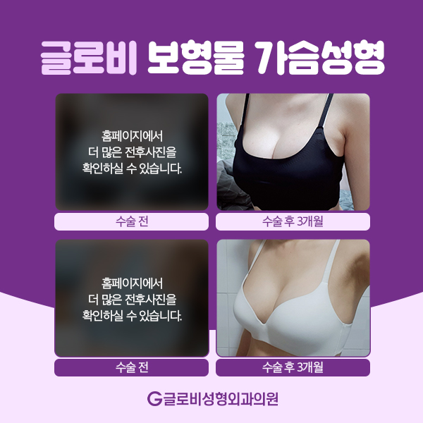 모티바가슴성형 보형물에 대해 알아보자 관련 이미지 10