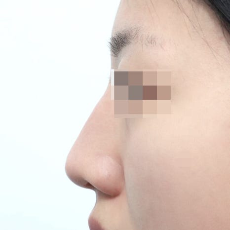Natural-Yet-Glamorous Rhinoplasty: Is It Possible to Achieve Both Glamour and Naturalness? image 4