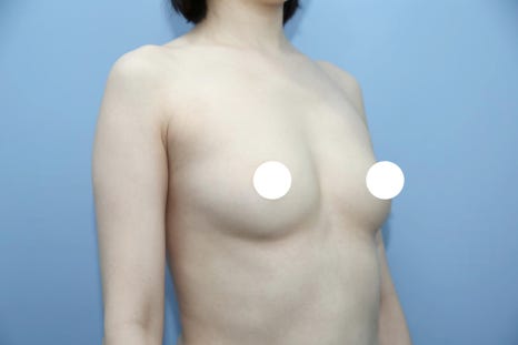 구형구축 재수술, 딱딱해진 가슴을 다시 부드럽게 되돌리는 법 관련 이미지 2