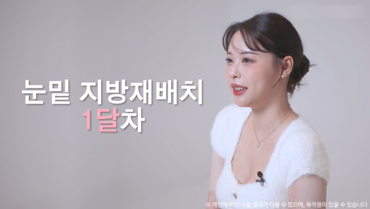 눈밑지방재배치수술 리얼후기 2탄｜수술 한달 후 경과확인! 관련 이미지 6