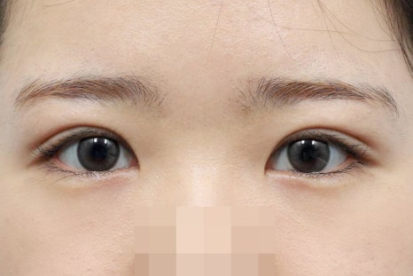 Sleepy-Looking Eyes: Causes to Check Before Simple Double-Eyelid Surgery image 3