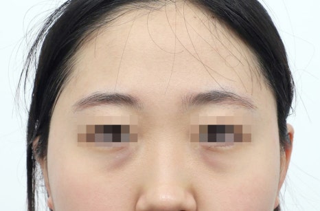 Lower Eyelid Fat Repositioning Side Effects: What You Should Know to Help Prevent Them image 2