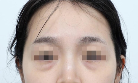 눈밑지방재배치 복시 생기면 이상한 걸까요 관련 이미지 2