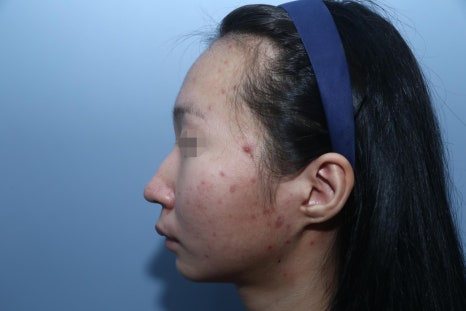 Autologous Dermal Graft Rhinoplasty: Read This If You’re Concerned About Resorption image 4