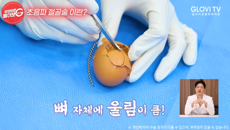 압구정역성형외과 코성형, 초음파절골술로 안전하게 관련 이미지 9