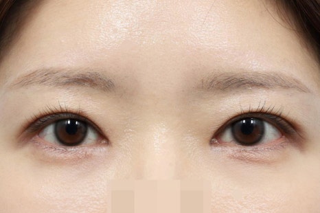 Sleepy-Looking Eyes: Causes to Check Before Simple Double-Eyelid Surgery image 6