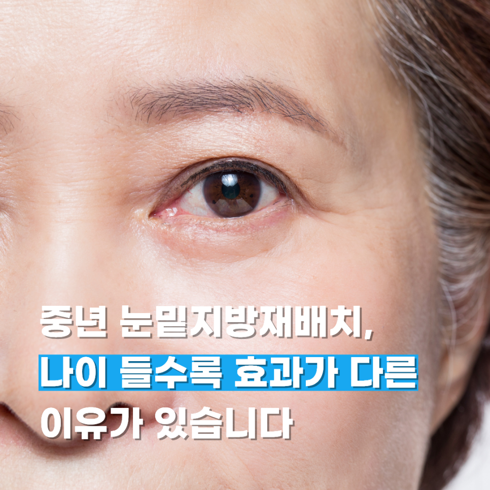 중년 눈밑지방재배치, 나이 들수록 효과가 다른 이유가 있습니다 관련 이미지 1