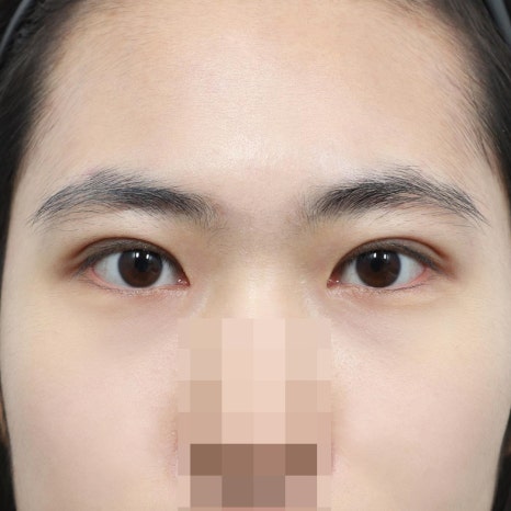 압구정 쌍수, 내 눈에 맞는 수술법 선택 가이드 관련 이미지 7