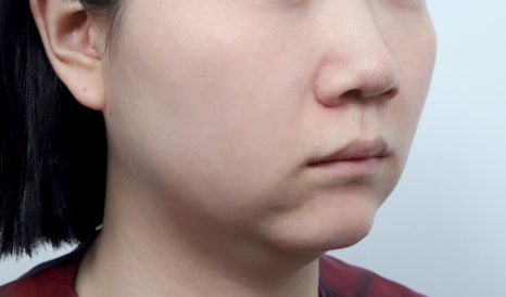 Why You May Regret Choosing a Thread Lift Based on Cost Alone image 2