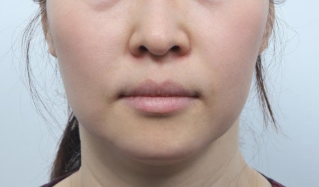 실리프팅 후 딤플, 생겼다면 마사지보다 먼저 알아야 할 것 관련 이미지 6