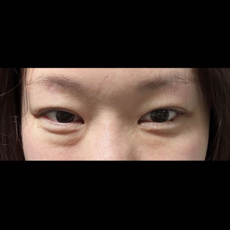 30대 눈밑지방재배치, 왜 지금 하는 게 맞는 걸까요? 관련 이미지 4