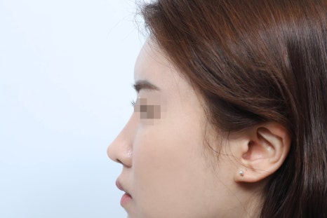 Analysis of the Causes of Failed Revision Rhinoplasty in Seoul and Personalized Plans image 4
