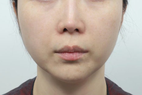 인중축소 잘하는곳, 입술이 어색해지는 부작용을 낮추는 수술법 관련 이미지 2