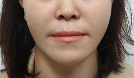 Sinsa Station Thread Lifting: What to Check When You’re Concerned About Skin Elasticity image 6