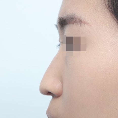 코성형가격 차이, 비용 결정하는 핵심 요소 분석 관련 이미지 7