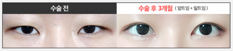Worried About Re-adhesion After Lateral Canthoplasty? Those Concerns Disappear When the Surgical Technique Is Different image 9
