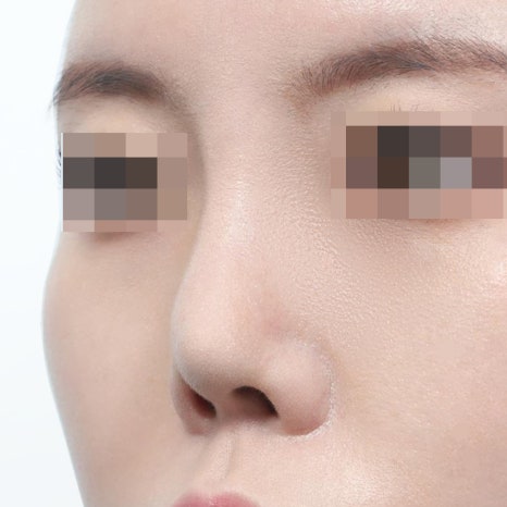 Rib Cartilage Rhinoplasty: When Rib Cartilage Is Used in Rhinoplasty image 4