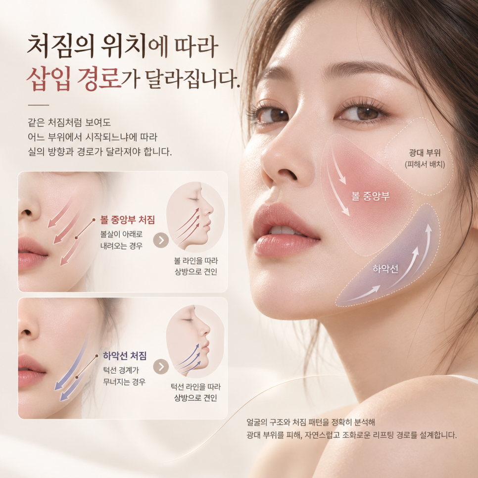 실리프팅 설계 원리, 어떻게 결정할까? 관련 이미지 3