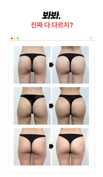 골반필러 시술 후 관리? 이 시기를 어떻게 보내느냐가 결과를 바꿉니다 관련 이미지 7