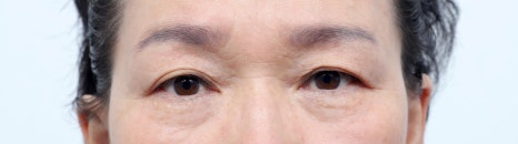 Upper Blepharoplasty: How to Improve Covered, Drooping Eyelids image 5