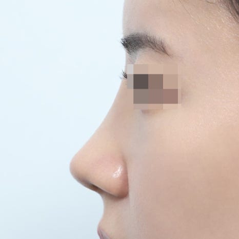 Tips for Managing the Recovery Period After Summer Vacation Rhinoplasty image 5