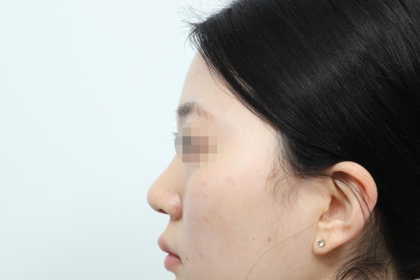 비중격 코성형 특징과 수술 전 확인해야 할 장단점 관련 이미지 6