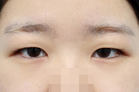 Sleepy-Looking Eyes: Causes to Check Before Simple Double-Eyelid Surgery image 2