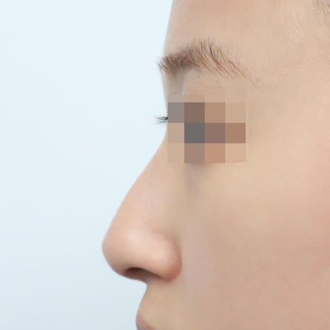 코재수술 시기 최소 6개월을 기다려야 하는 이유 관련 이미지 3